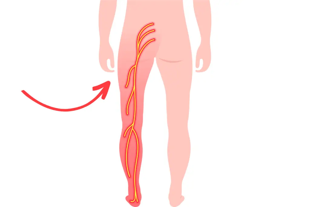 Diagram of the sciatic nerve