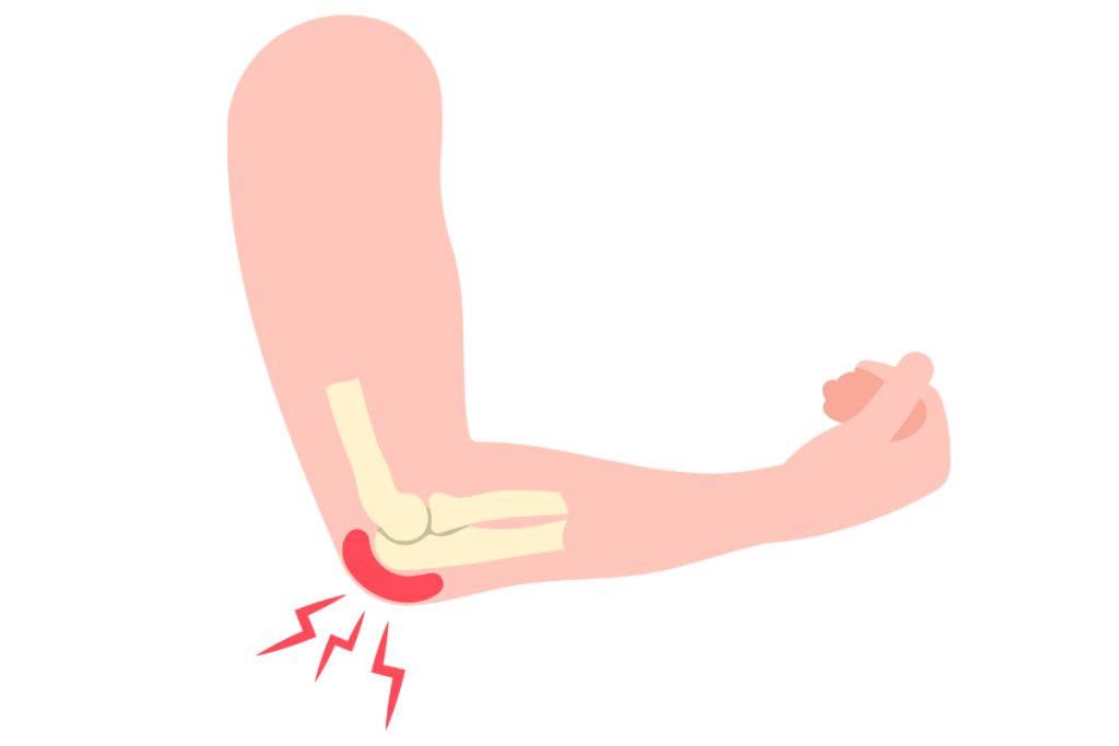 Diagram showing tennis elbow pain