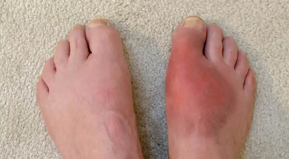 Gout affecting the foot - photo
