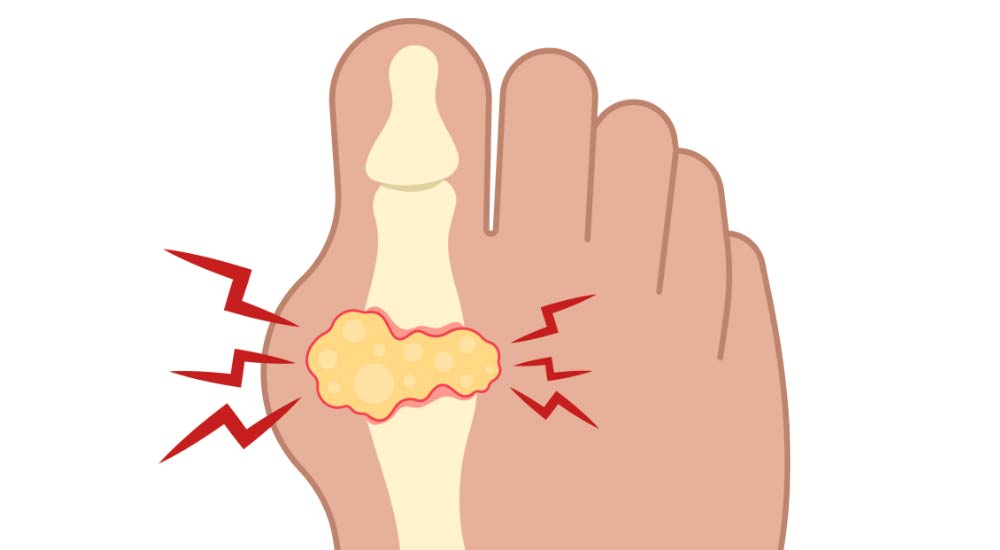 Gout affecting toe joint - diagram illustration