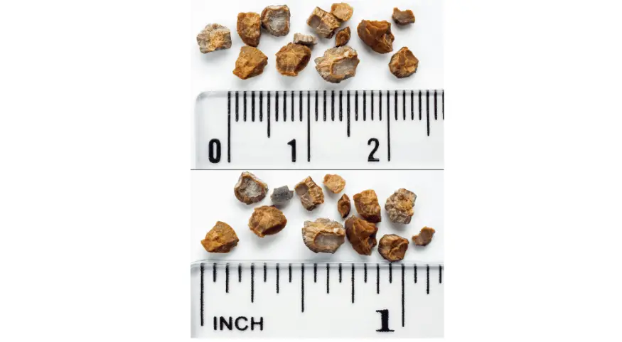 Photo of real kidney stones, showing their size against a ruler 
