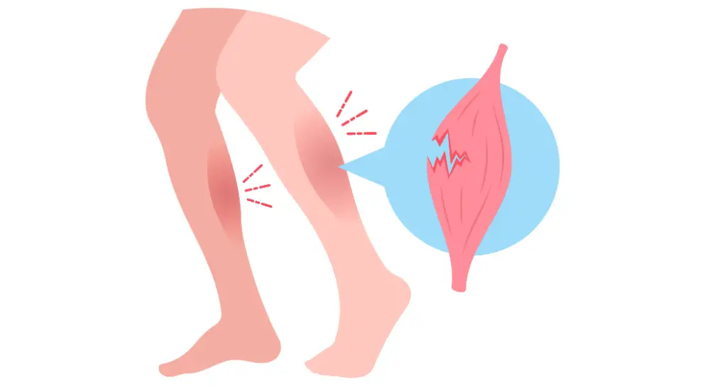 torn calf muscle - illustration