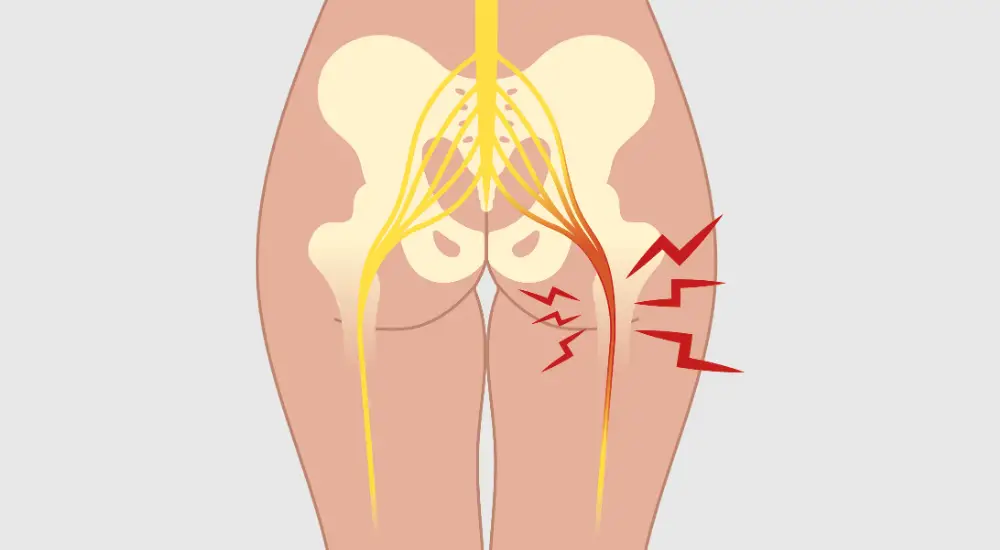sciatic nerve pain - diagram